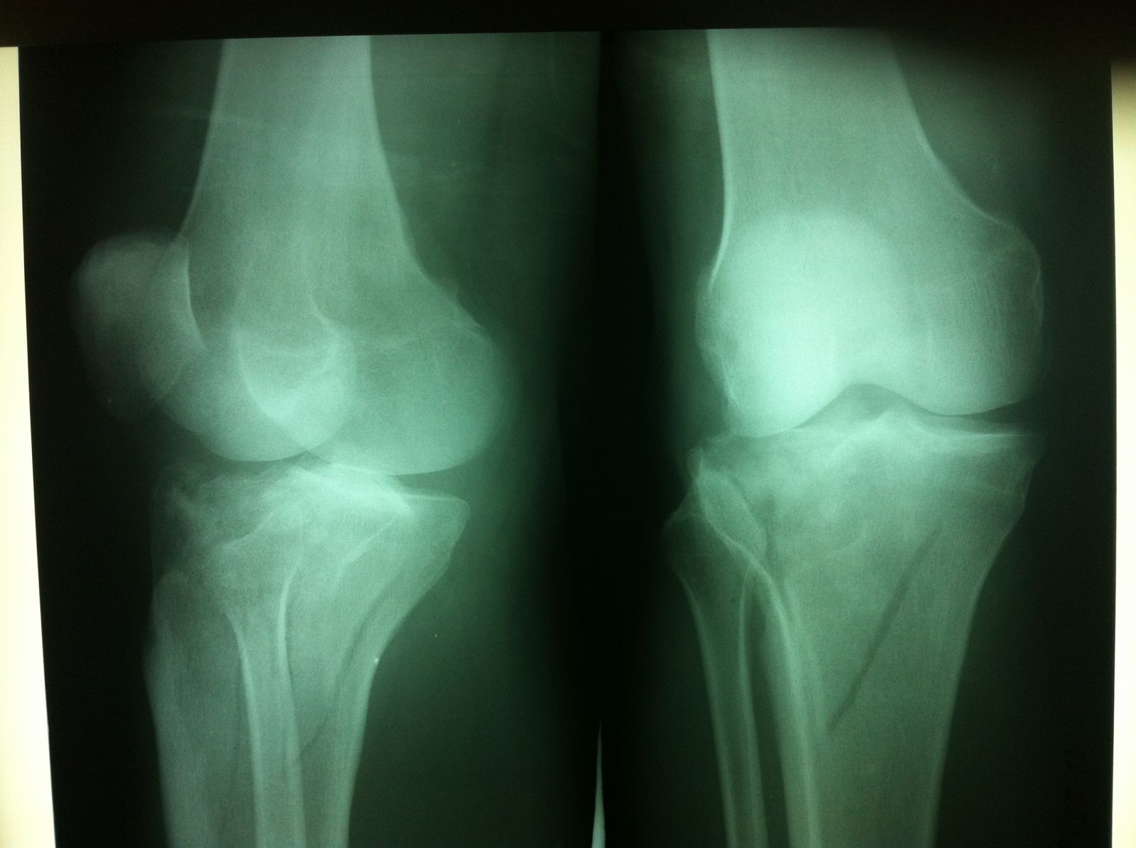 Рентген колена. Гемартроз коленного сустава рентген. Гемартроз тазобедренного сустава.